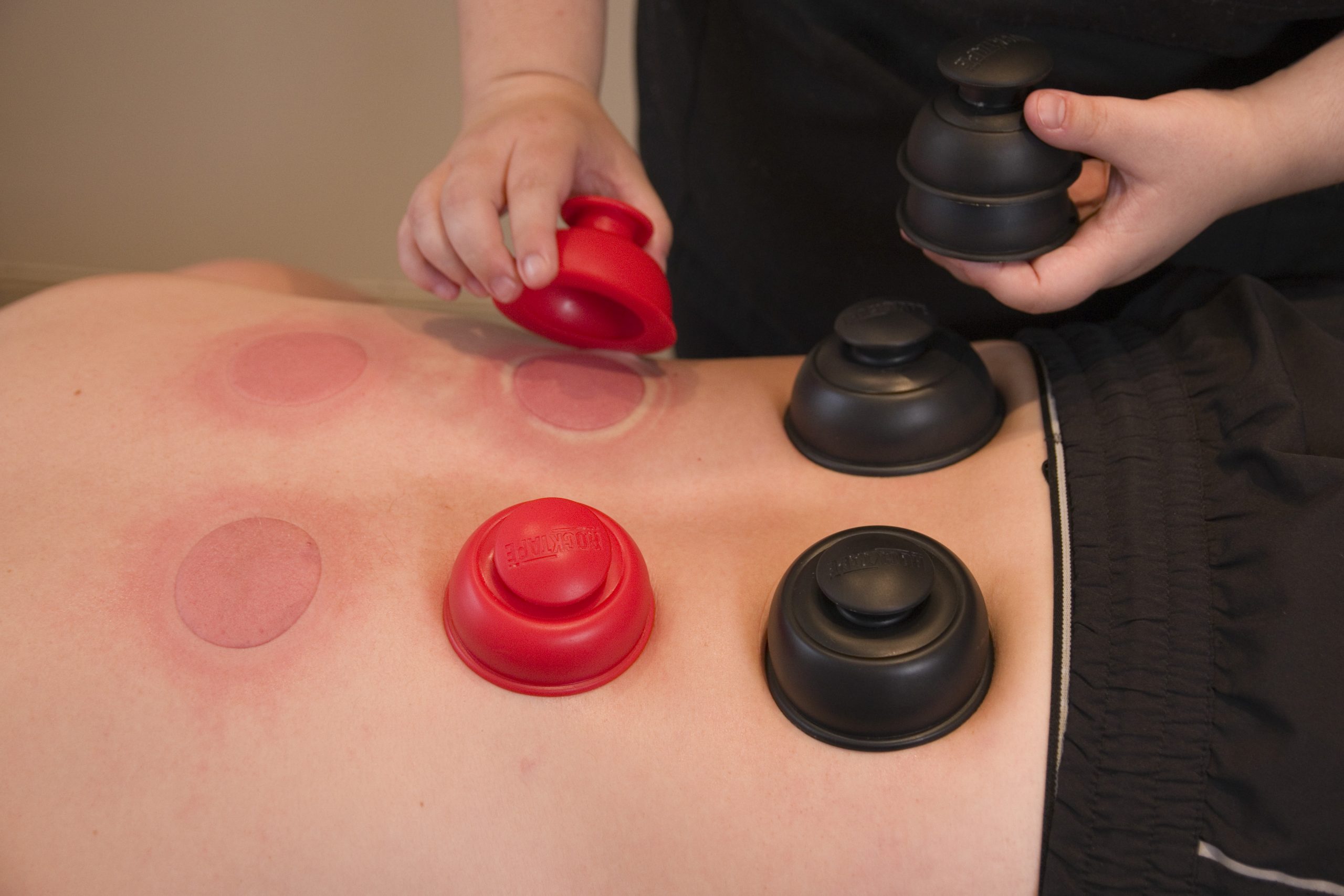 Dry cupping marks